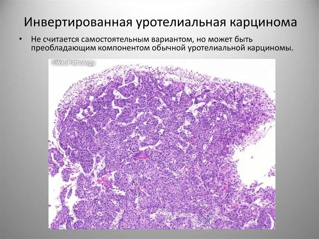 Переходно клеточная карцинома мочевого пузыря гистология. Папиллярная уротелиальная карцинома мочевого пузыря g2. Аденокарцинома мочевого пузыря гистология. Папиллярная карцинома мочевого пузыря гистология. Злокачественный потенциал