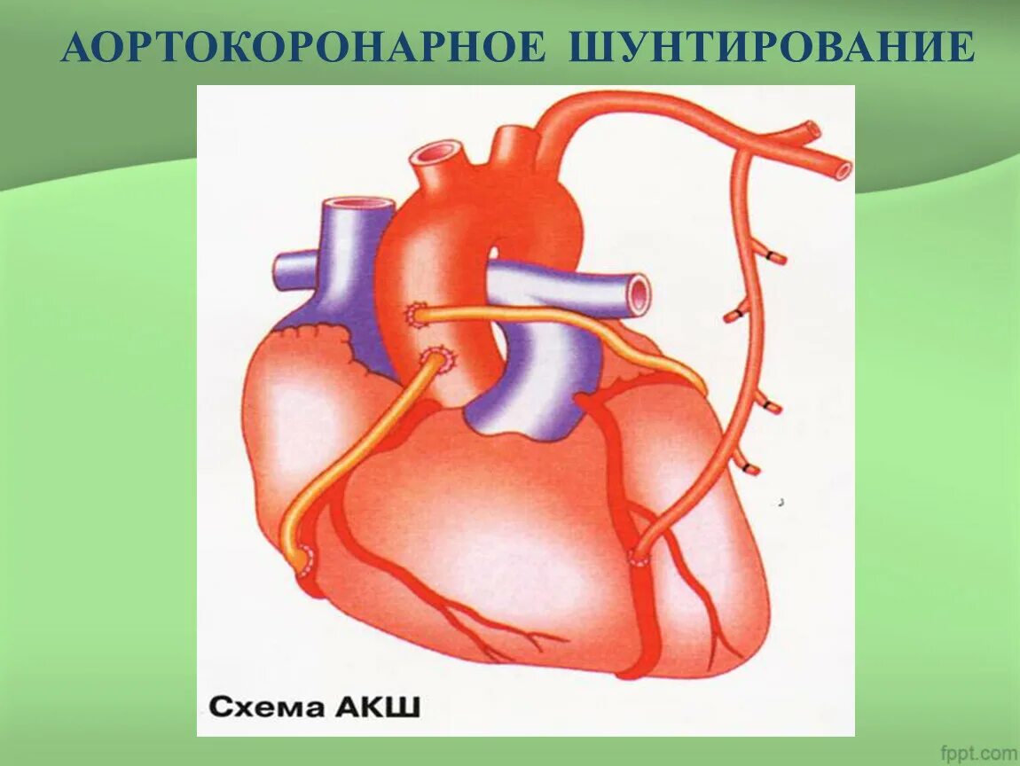 Операция коронарный сосуд. Аорто-коронарное шунтирование. Схема операции аортокоронарного шунтирования. Порто коронарное шунтирование. Аорто копонарное шунтирование.