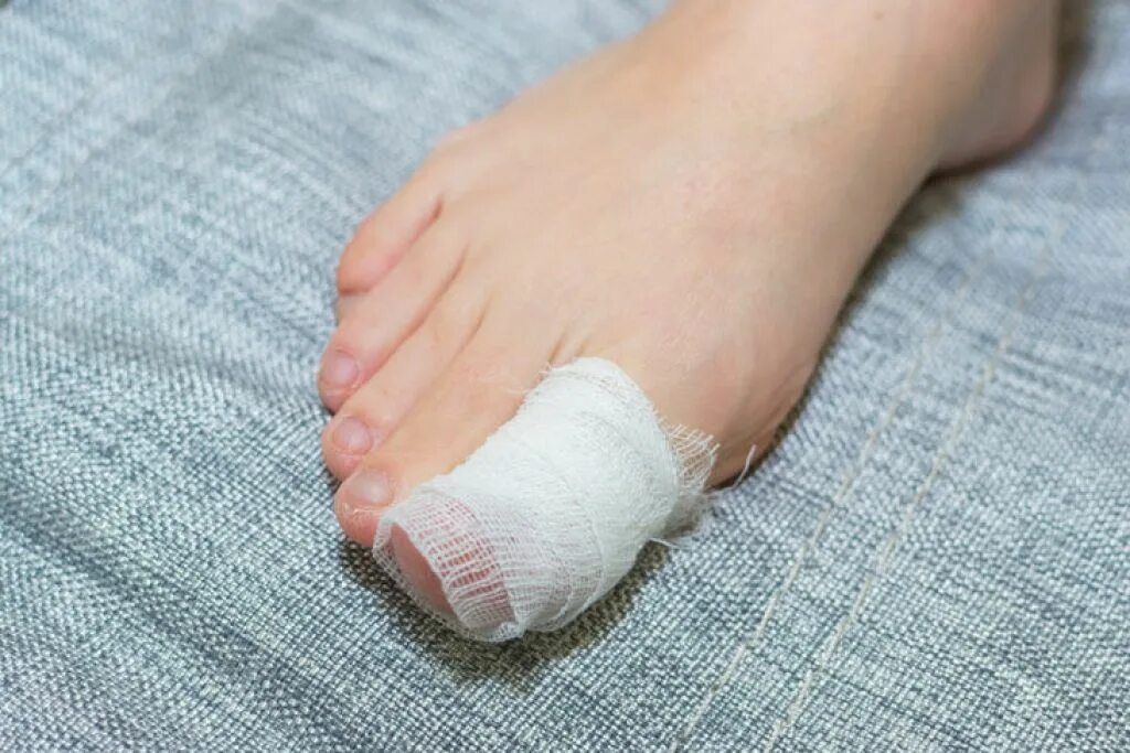 Лечение трещин между. Забинтованный палец на ноге. Компресс для ног от грибка.
