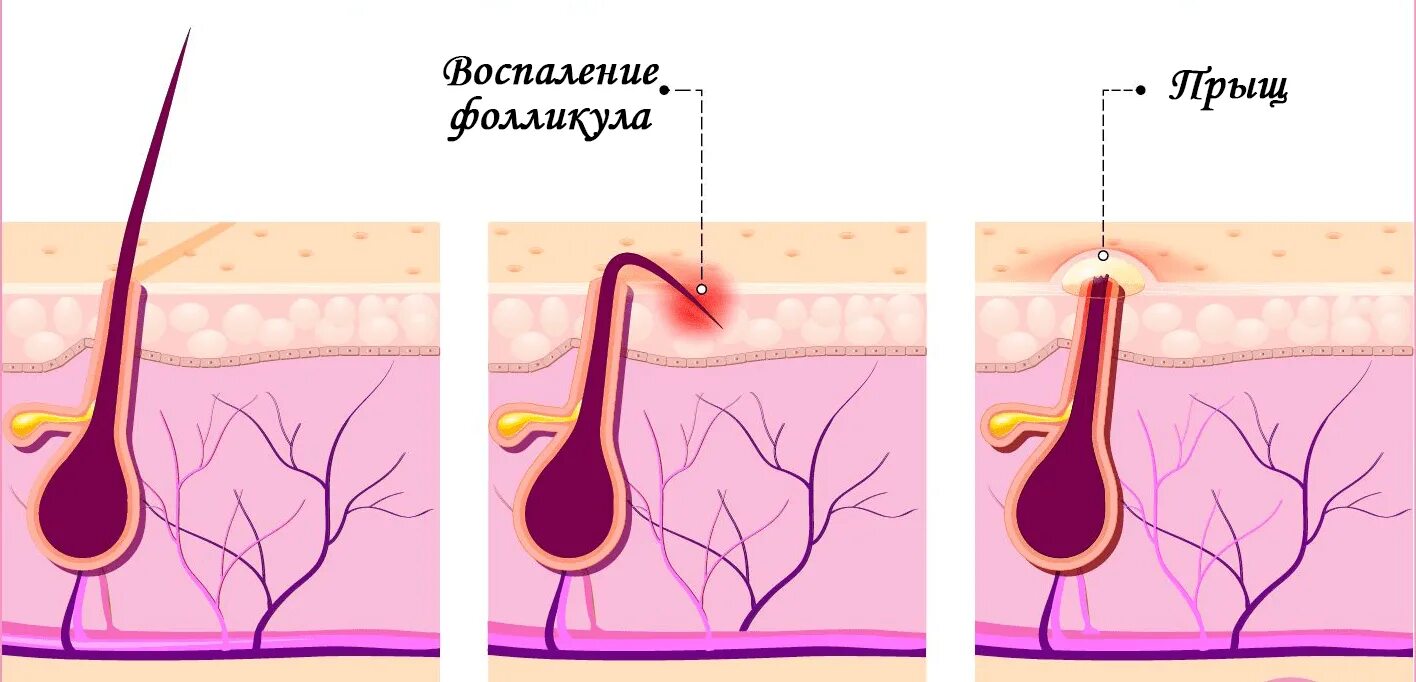 Волосяные зоны