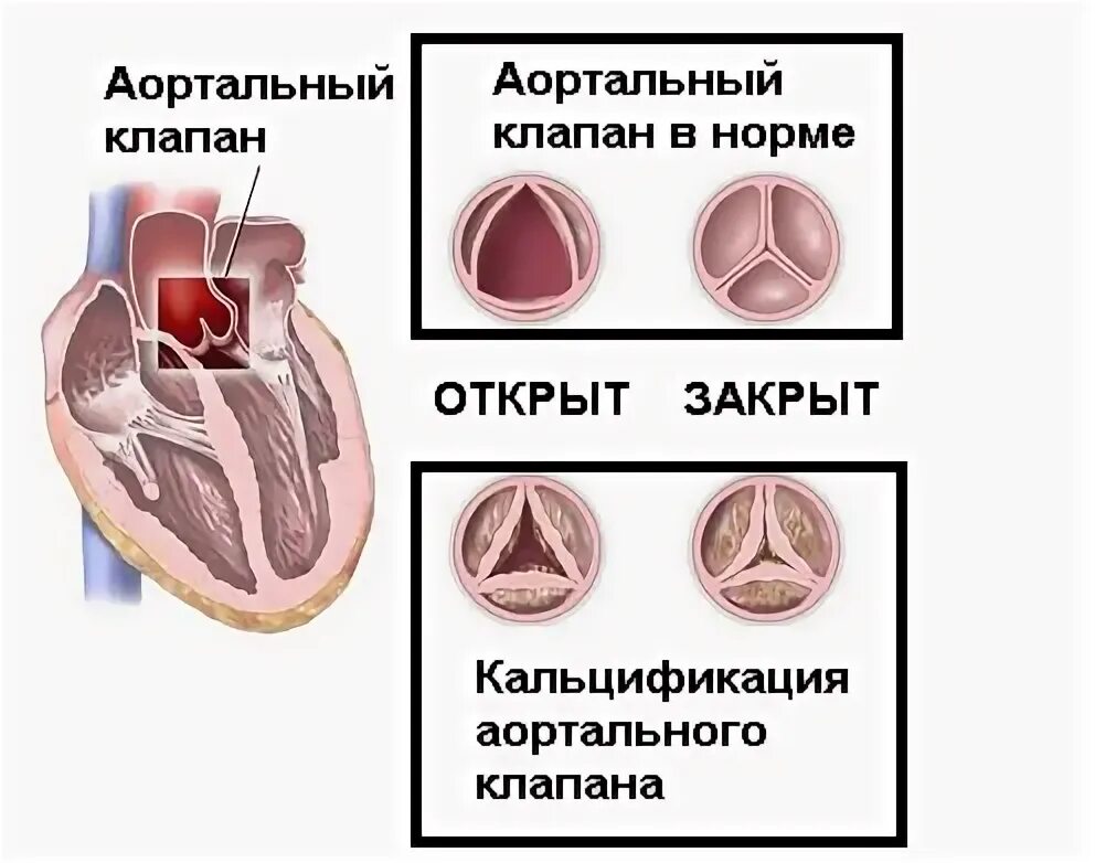 Кальциноз митрального клапана. Кальцинаты створок аортального клапана. Кальциноз аортальный клапан сердца. Дегенеративный стеноз аортального клапана. Кальциноз створок аортального клапана 1 степени.