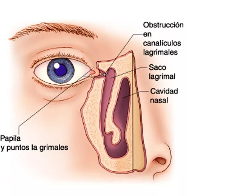 Слезные каналы где. Носослезный мешок анатомия. Воспален слезный мешок. Воспаление слезного мешочка. Воспаление глазного мешочка.