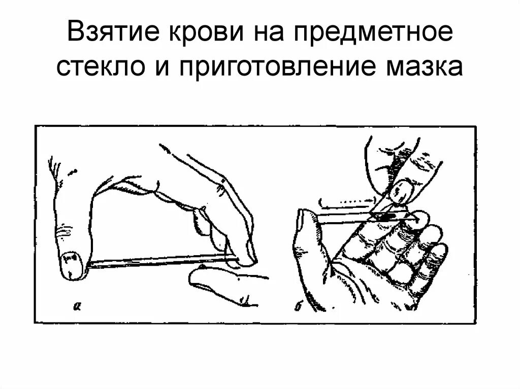 Манипуляция взятие. Техника взятия капиллярной крови. Алгоритм взятия капиллярной крови. Приготовление мазка крови алгоритм. Взятие крови и приготовление мазков.