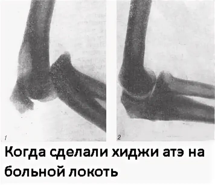 Подвывих локтевого сустава у ребенка. Передний вывих предплечья рентген. передний вывих локтевого сустава рентген. передний вывих костей предплечья рентген. подвывих локтевого сустава.