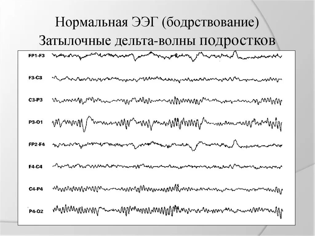 О чем говорит ээг. Полифазные волны на ЭЭГ. Высокоамплитудные Дельта волны на ЭЭГ. Дельта активность на ЭЭГ. Вспышки Дельта волн на ЭЭГ.