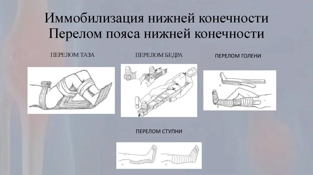 Д3 при переломах. Техника транспортной иммобилизации при переломе костей голени. Транспортная иммобилизация конечностей алгоритм. Переломы вывихи транспортная иммобилизация. Мобилизация нижних конечностей.