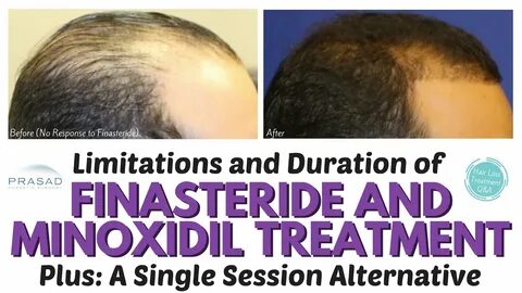 When to take finasteride during day 10. day take 10 during to finasteride w...
