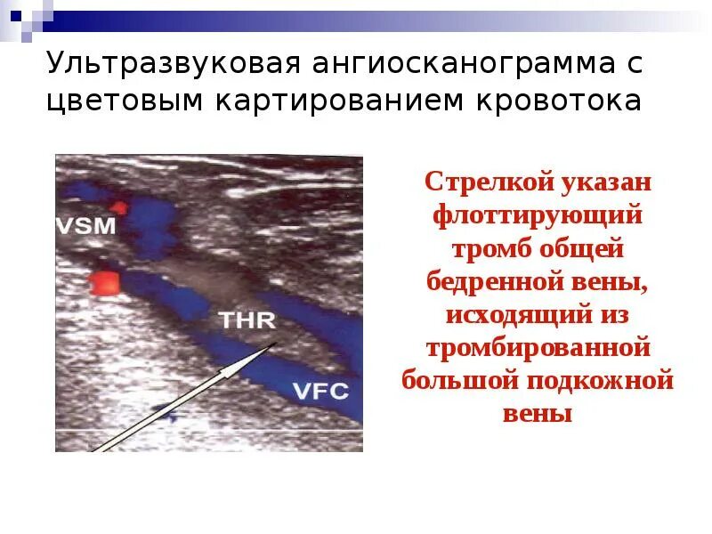 Тромбофлебит карта вызова. Тромбофлебит презентация. Общая бедренная Вена тромбирована. Тромбофлебит краткосрочная цель.