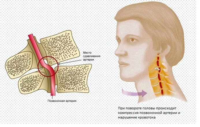 При поворотах головы кружится голова причины. Синдром позвоночной артерии с4. Компрессия позвоночной артерии шейного отдела. Позвоночная артерия аномалия Киммерли. Сдавление позвоночной артерии шейного отдела.