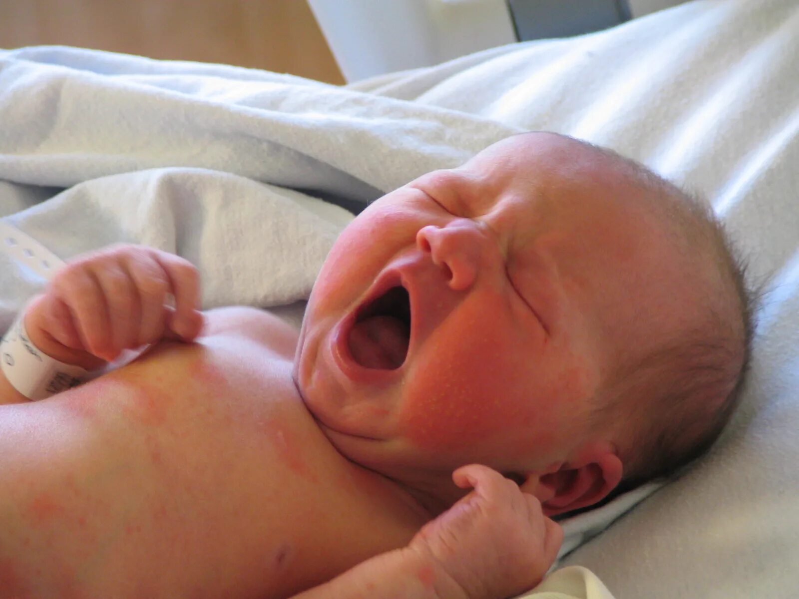 Пук новорожденных. Токсическая эритема новорожденных. Физиологическая эритема новорожденных. Физиологическая ритейла у новорожденных. Транзиторная эритема новорожденных.