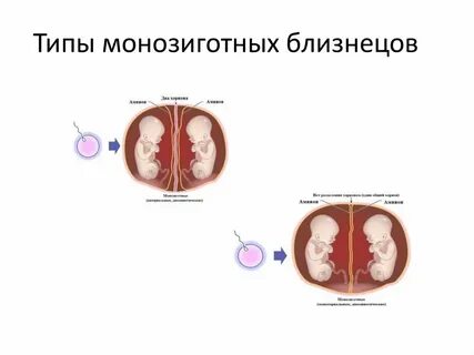 Монозиготные близнецы