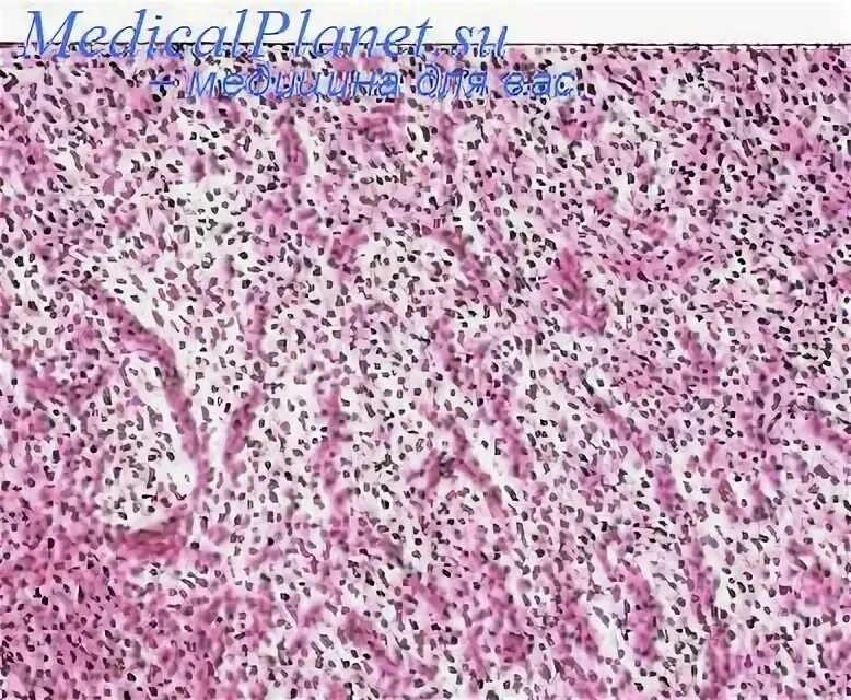 Стромальная саркома. Стромальная саркома матки гистология. Эндометриальная стромальная саркома гистология. Эндометриальная саркома матки гистология. Стромальная саркома эндометрия гистология.