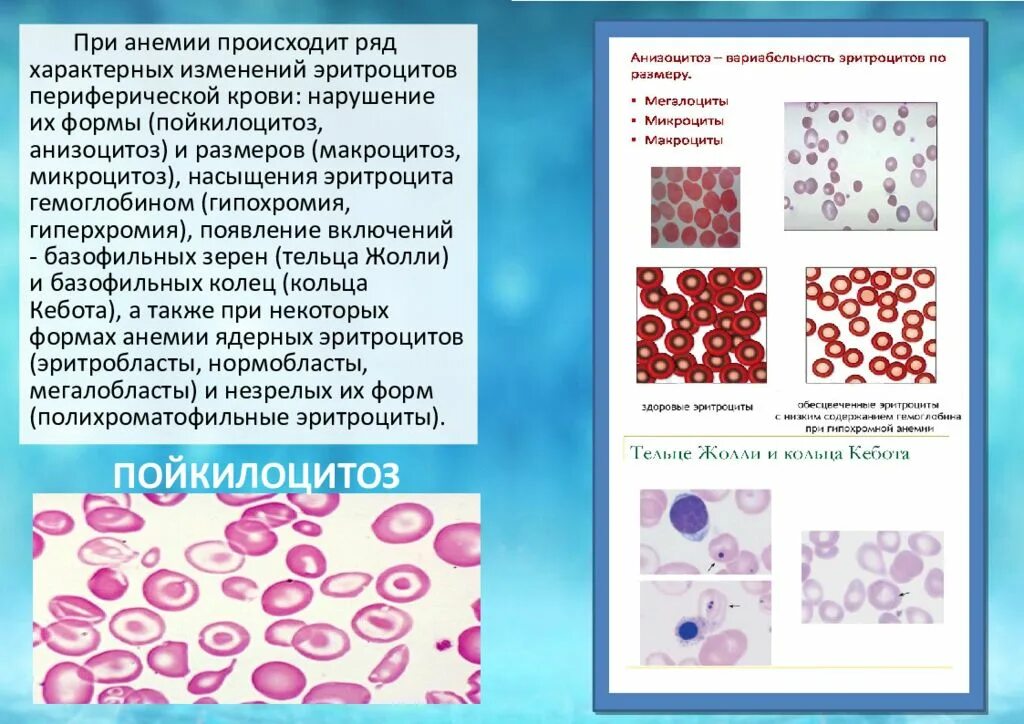 Пониженные макроциты. Анизоцитоз пойкилоцитоз анизохромия. Микроцитоз анизоцитоз пойкилоцитоз. Анизоцитоз и пойкилоцитоз эритроцитов. Гипохромия и микроцитоз эритроцитов.