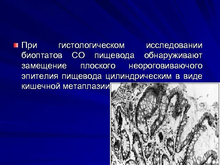 Метаплазия желудка гистология. Кишечная метаплазия гистология. Метаплазия эпителия пищевода. Полная метаплазия желудка