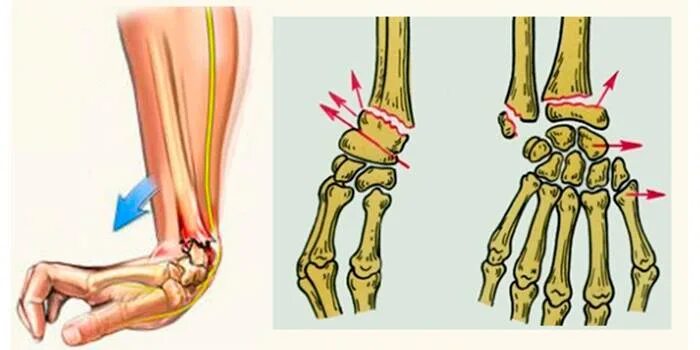 Смещение кости на руке без перелома. Перелом дистального конца лучевой кости. Перелом ДМЭ лучевой кости. Разгибательный перелом лучевой кости. Перелом лучевой кости (Коллиса):.