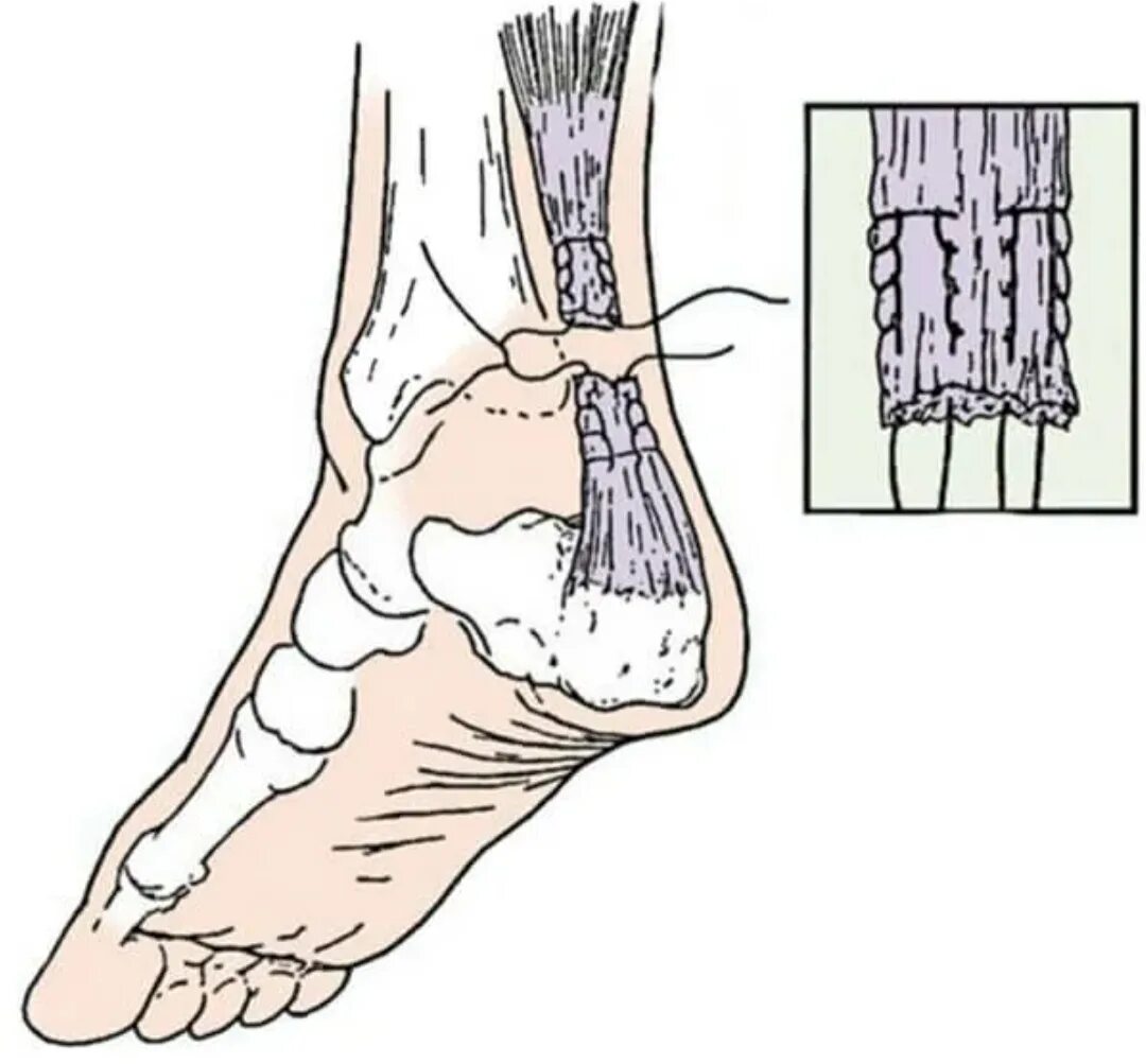 Шов ахиллова сухожилия. Отрыв ахиллесова сухожилия. Разрыв Ахилесова сухожилия. Операция шов ахиллова сухожилия. Ахиллово сухожилие разрыв ахиллова сухожилия
