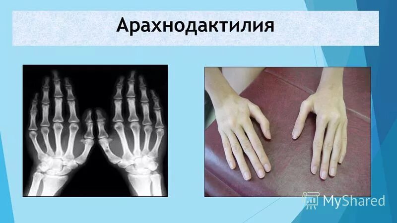 арахнодактилия наследуется как доминантный