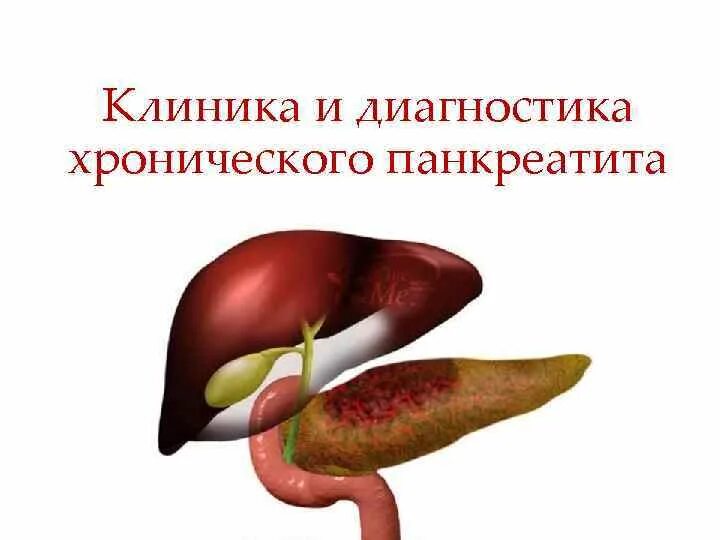 Панкреатит хронического течения. Хронический панкреатит клиника. Клиника осложнений хронического панкреатита. Панкреатит клиника диагностика. Осложнения панкреатита.