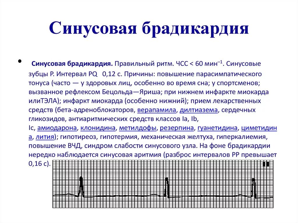 Синусовая брадикардия симптомы. Брадикардия на ЭКГ. ЭКГ умеренная синусовая брадикардия. Синусовая брадикардия на ЭКГ.