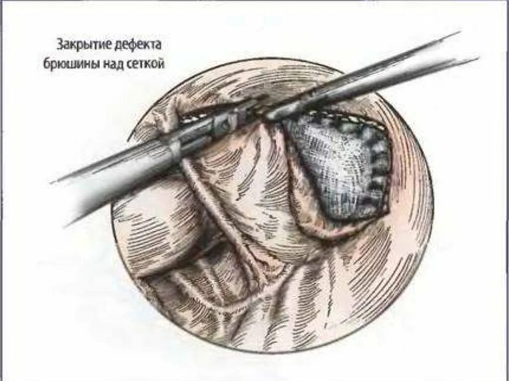 Больничный после операции на паховой грыже. Паховая грыжа: лапароскопическая герниопластика. Лапароскопическая герниопластика Тарр. Tapp пластика паховой грыжи. Паховая грыжа операция лапароскопия.