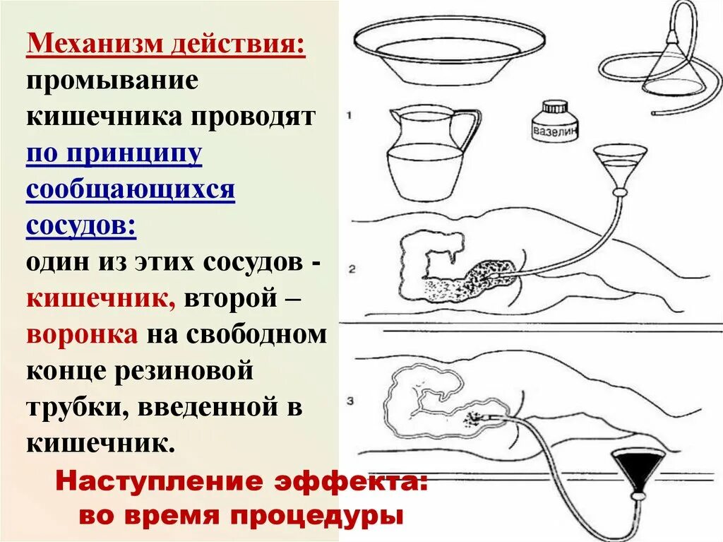 Промывание желудка сифонная клизма алгоритм. Газоотводная клизма механизм действия. Газоотводная трубка клизма механизм действия. Постановка газоотводной трубки алгоритм. Алгоритм действия очистительной