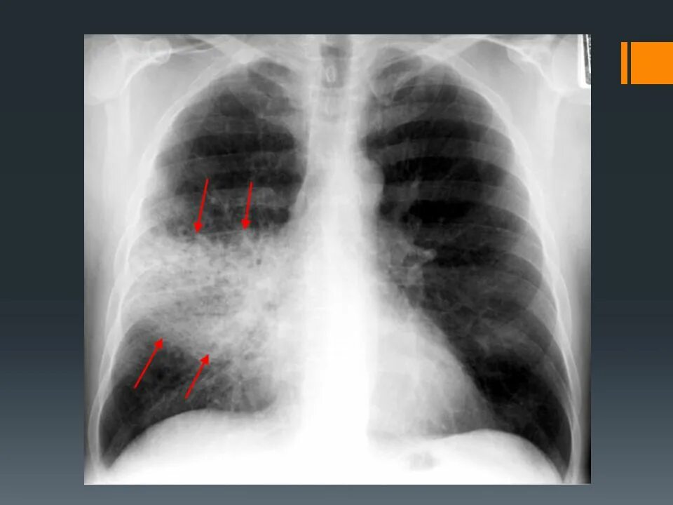 Поражением легких 50. Рентген легких крупозная пневмония. Рентгенография крупозной пневмонии. Крупозная пневмония рентгенограмма. Крупозная пневмония рентгенологическая картина.