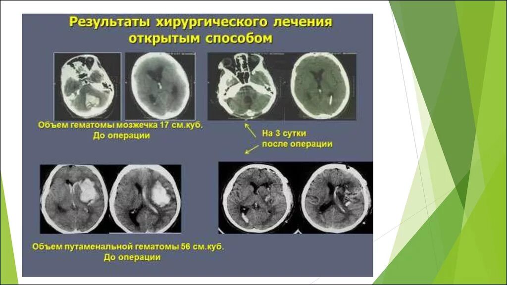 Операция при геморрагическом инсульте. Хирургические вмешательства при геморрагическом инсульте. Геморрагический инсульт операция. Хирургические методы лечения инсульта. При инсульте делают операцию