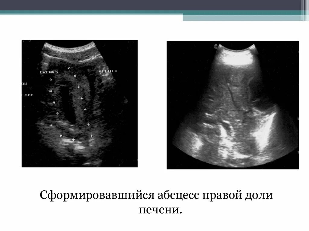 Очаговое образование в правой доле в. Абсцесс печени презентация. Ультразвуковая диагностика заболеваний печени. УЗИ диагностика абсцессов печени.