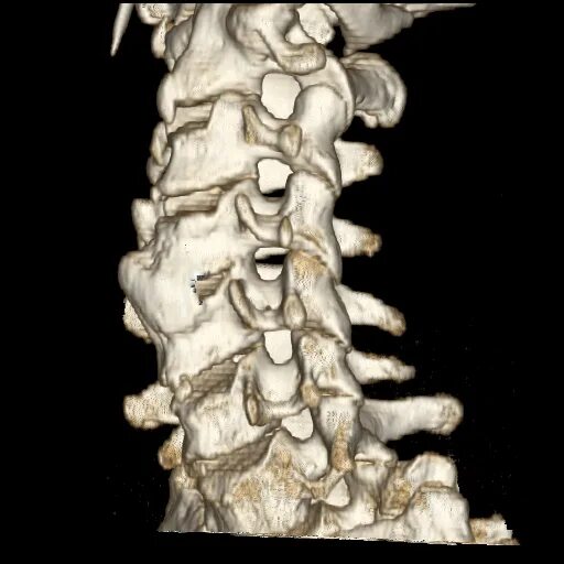 Синдесмофиты позвоночника на кт. Аномалия позвонка полурасщепленный. Аномалии развития с2 позвонка.