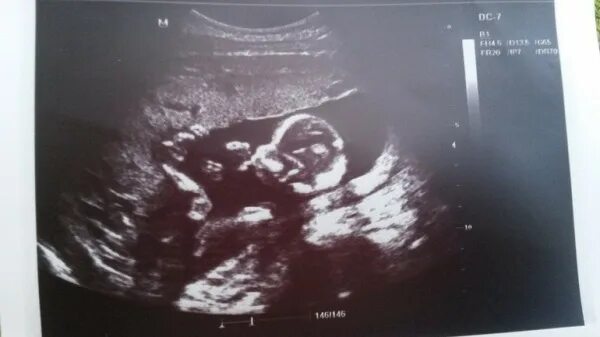 Узи 18 недель беременности. Ребёнок на 17 неделе беременности узи. Узи 17 недель беременности. 17 неделя 18 года. Беременный живот 17 недель.