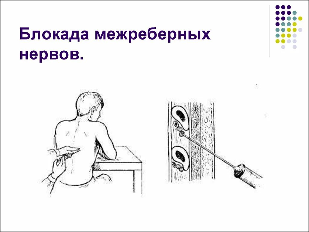 Блокада показания. Межреберная новокаиновая блокада показания техника. Техника новокаиновой блокады межреберных нервов. Межреберная новокаиновая блокада техника. Новокаиновые блокады перелом ребер.