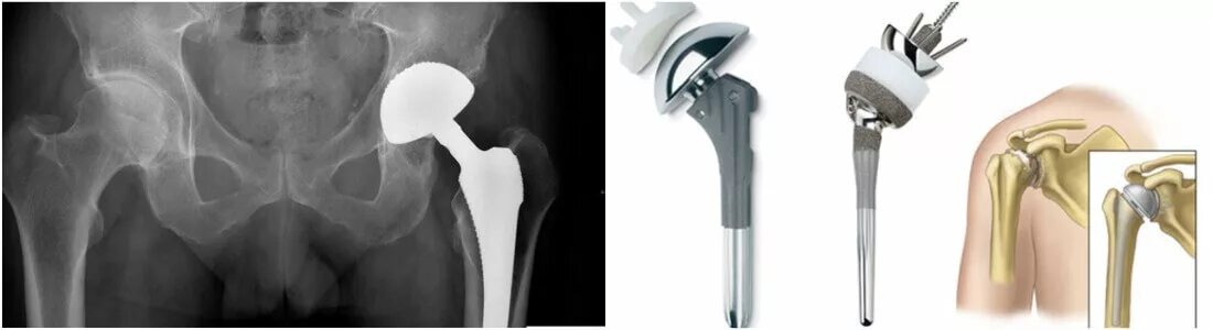 Операция по замене тазобедренного как происходит. Тазобедренный эндопротез Райт. Эндопротезирование тазобедренного сустава DEPUY. Эндопротезирование тазобедренного сустава мкб 10. Депью протез тазобедренного сустава.