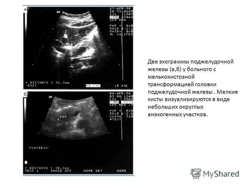 Диффузные изменения киста поджелудочной железы. Диффузные изменения киста поджелудочной железы