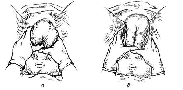 Самопроизвольные роды в затылочном предлежании. Акушерское пособие по Цовьянову 1. Ручного акушерского пособия по Цовьянову. Акушерское пособие по Цовьянову при чисто ягодичном предлежании. Акушерское пособие по Цовьянову 1 и 2.