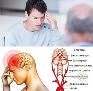 Мигрень москва