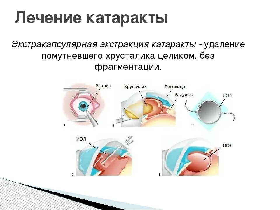 Катаракта схема глаза. Интракапсулярная и экстракапсулярная экстракция катаракты. К современным методам удаления катаракты относят. Катаракта экстракапсулярная экстракция.