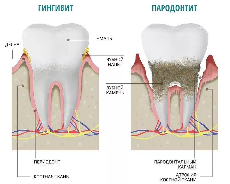 Пульсирующая боль в зубе причины