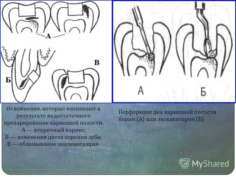 Ошибки препарирования кариозных полостей. Осложнения при препарировании кариозных полостей. Перфорация пульпы зуба при кариесе. Недостаточное препарирование (обработка) кариозной полости. Осложнения лечения кариеса