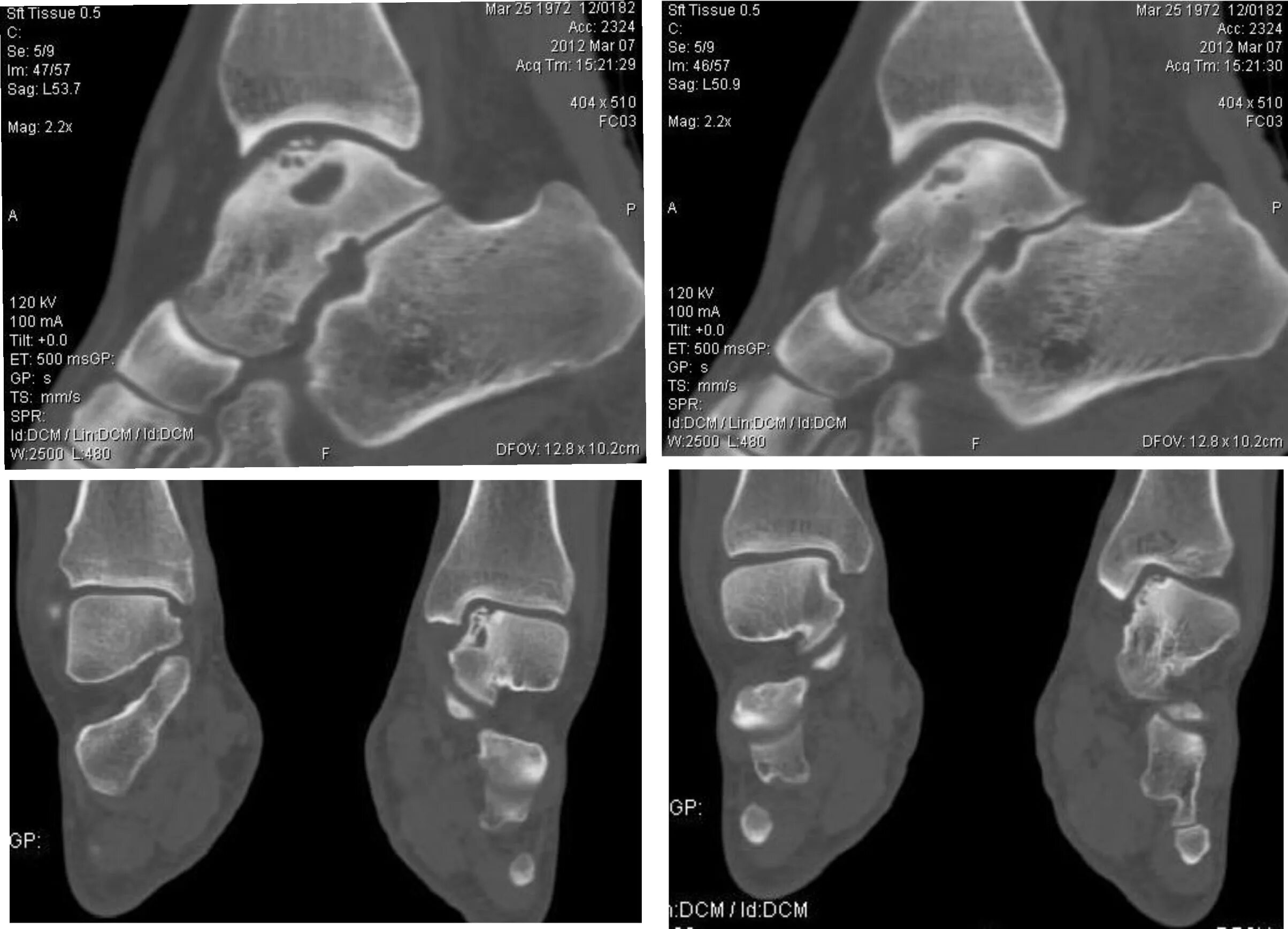 асептический некроз кости голеностопного сустава. асептический некроз таранной кости голеностопного сустава кт мрт. асептический некроз таранной кости кт. асептический некроз кости голеностопного сустава. остеохондропатия таранной кости рентген.