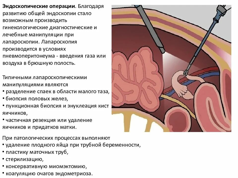 Лапароскопия показания. Лапароскопия маточных труб. Лапароскопическая операция в гинекологии. Лапароскопия малого таза. Эндоскопическая операция.