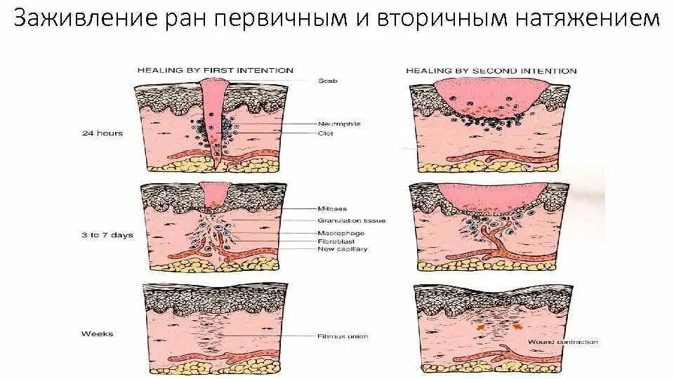 Через сколько заживает рана. Заживление РАН первичным натяжением. Заживление РАН вторичным натяжением. Этапы заживления РАН вторичным натяжением. Первичное и вторичное заживление РАН.