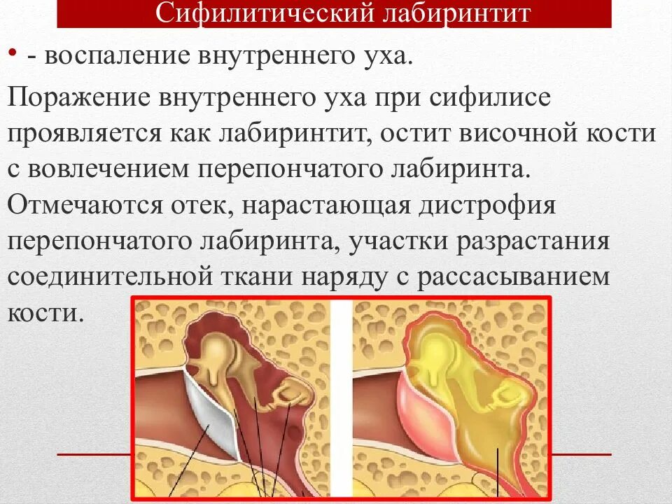 Внутреннее воспаление. Сифилитический лабиринтит. воспаление внутреннего уха (лабиринтит) возникает. лабиринтит температура.