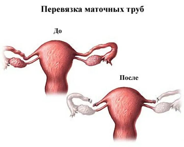 Перевязка маточных труб. Лапароскопическая операция перевязка маточных труб. Что такое перевязка маточных труб у женщин. Перевязка маточных труб методом лапароскопии. Если месячные если перевязать трубы