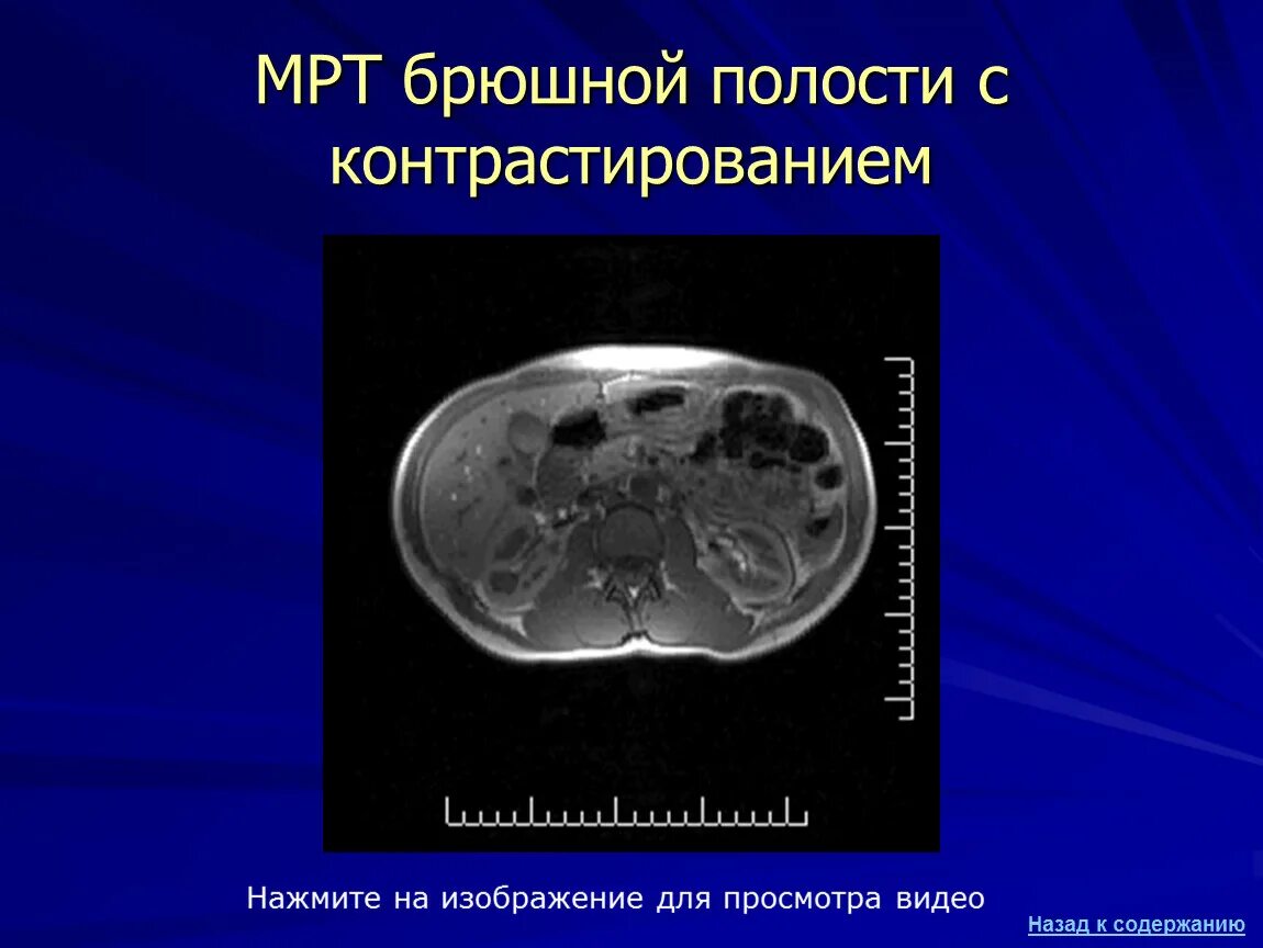 Компьютерная томография органов брюшной полости. Мрт брюшной полости с контрастированием. Мрт органов брюшной полости с контрастированием.