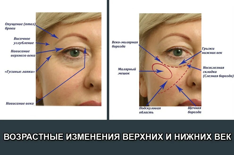 Смас лифтинг ultraformer 3. Возрастные изменения век. Зона нанесения крема вокруг глаз. Периорбитальная зона. Параорбитальная область.