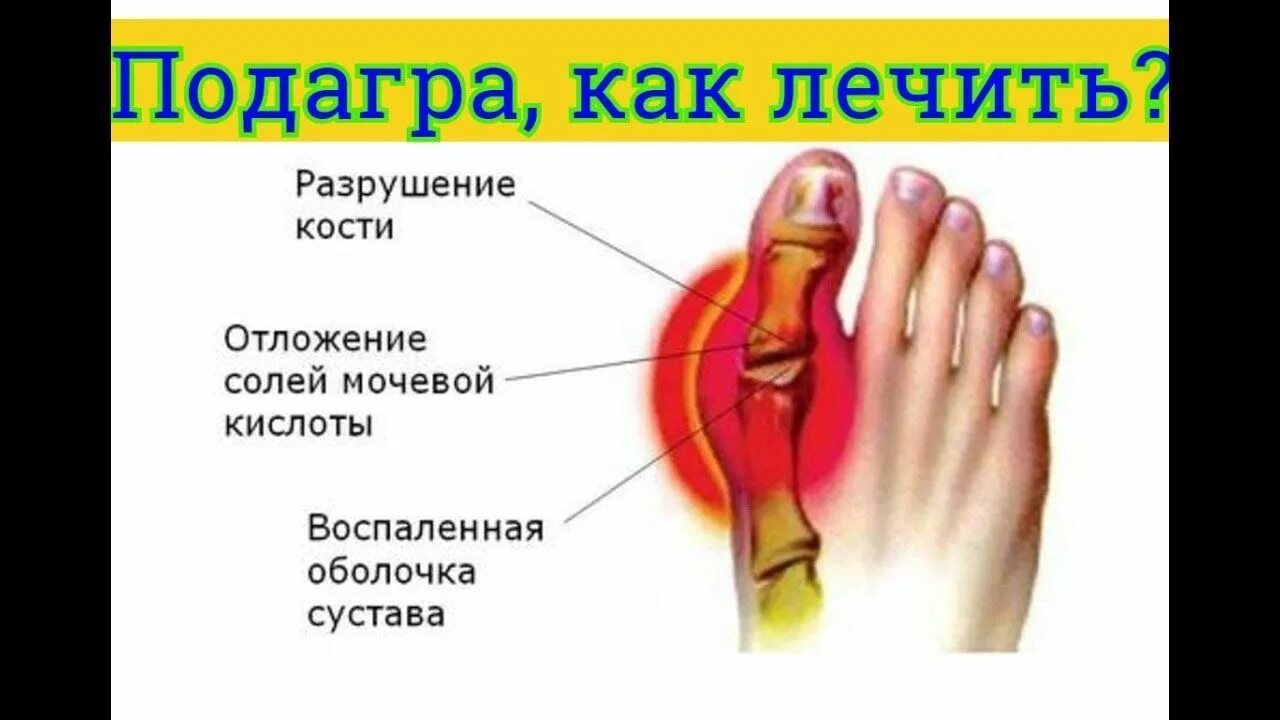 Подагра причины возникновения
