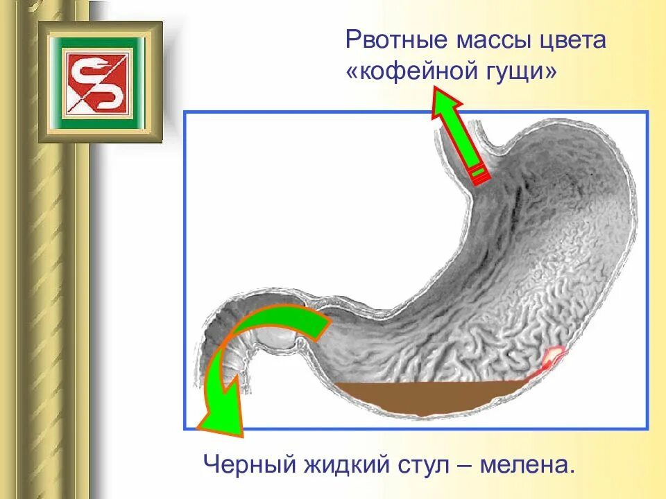 Рвотные массы цвета кофейной гущи. Желудочное кровотечение. Желудочно кишечного кровотечения мелена. Рвотная масса кофейная гуща