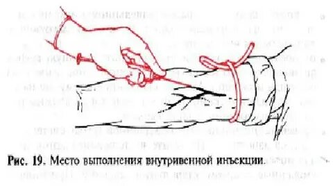 Гематома при внутривенной инъекции