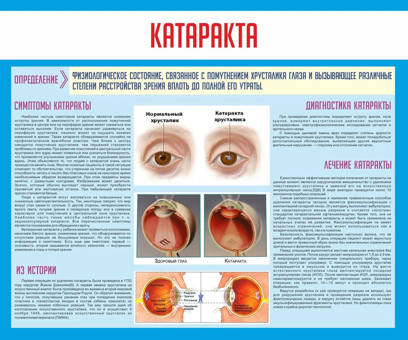 Санбюллетень катаракта. Постеры по офтальмологии. Памятка катаракта.