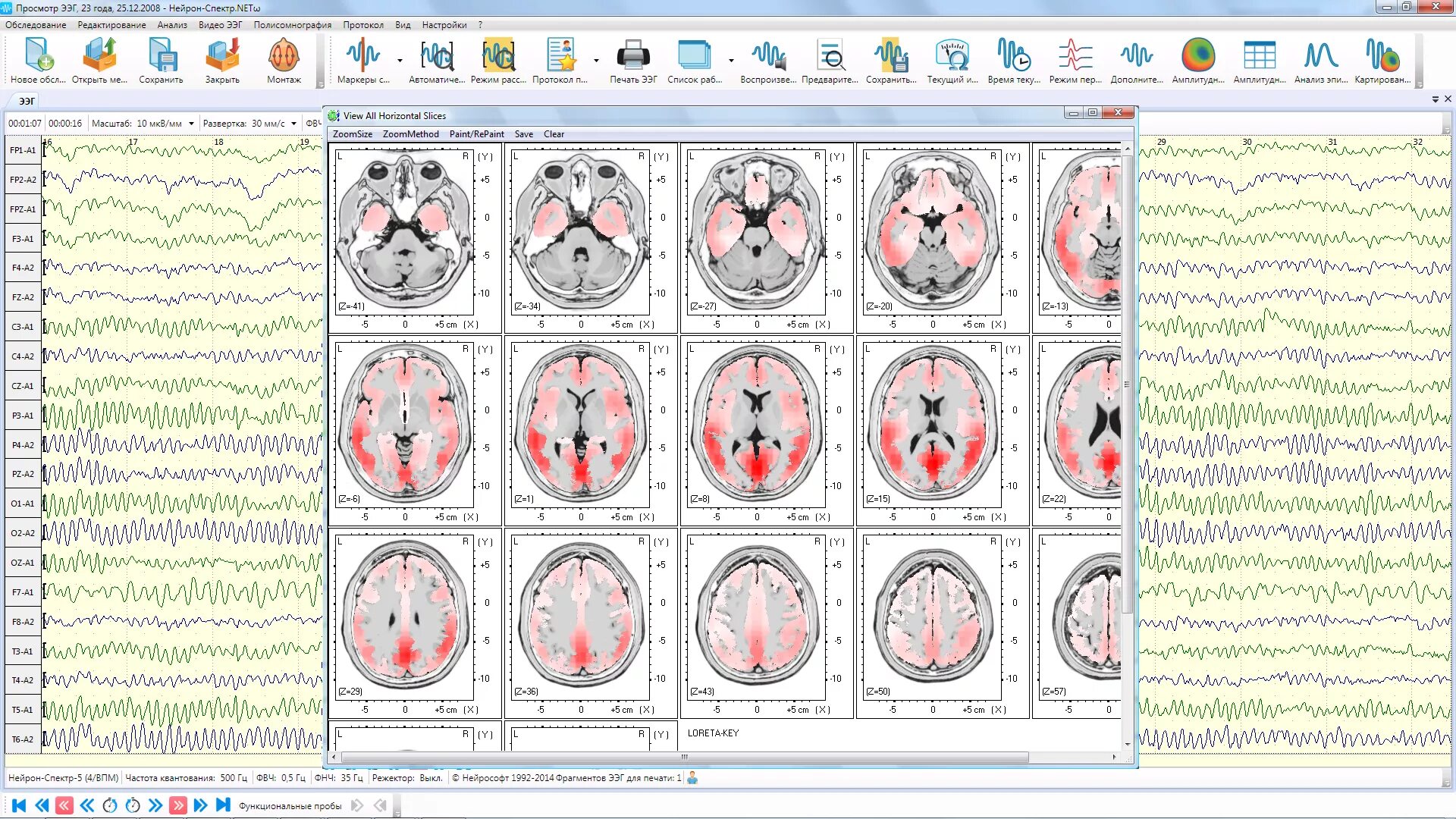 Ээг работа. Электроэнцефалограф Нейрон-спектр-2 (16-ти канальный ЭЭГ). Электроэнцефалограф 32-канальный Нейрон-спектр-5. Электроэнцефалограф Нейрон спектр 5. Электроэнцефалограф Нейрон-спектр-4/п.